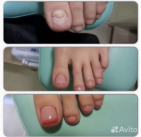 Педикюр медицинский.Титановые нити.Подолог