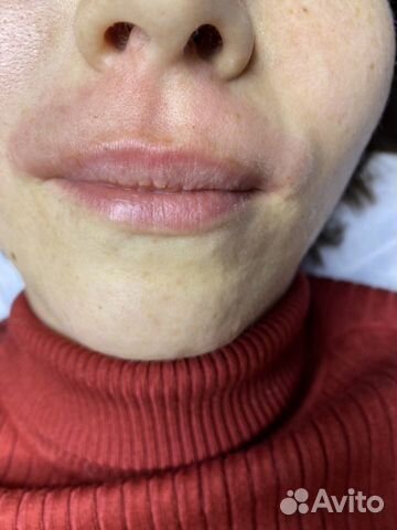 Электроэпиляция